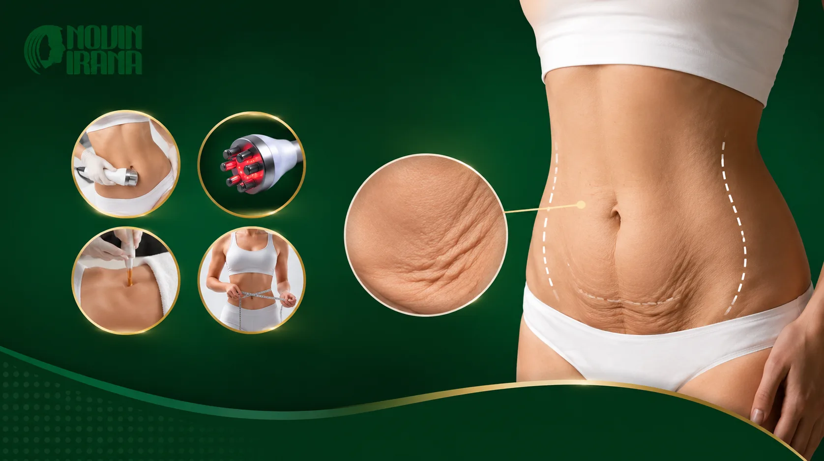 طرق علاج ترهل الجلد بعد شفط الدهون